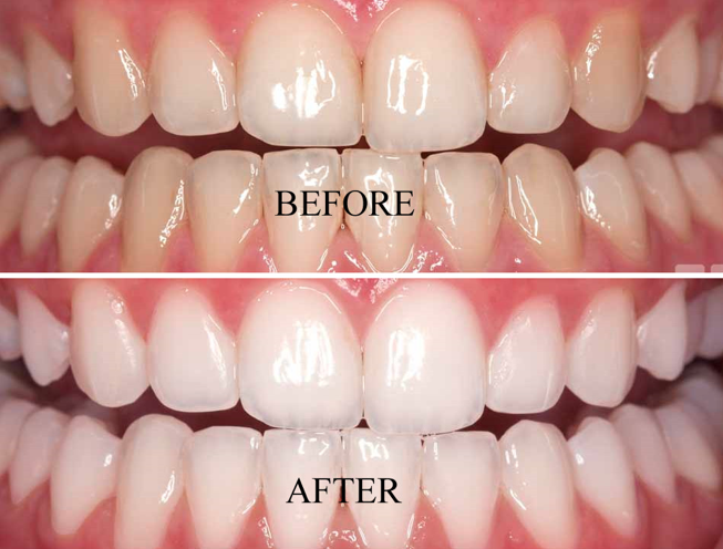 Teeth Whitening Treatment